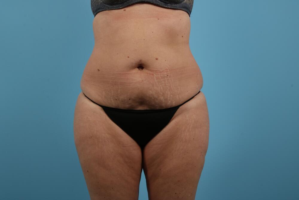 Abdominoplasty Before & After Image