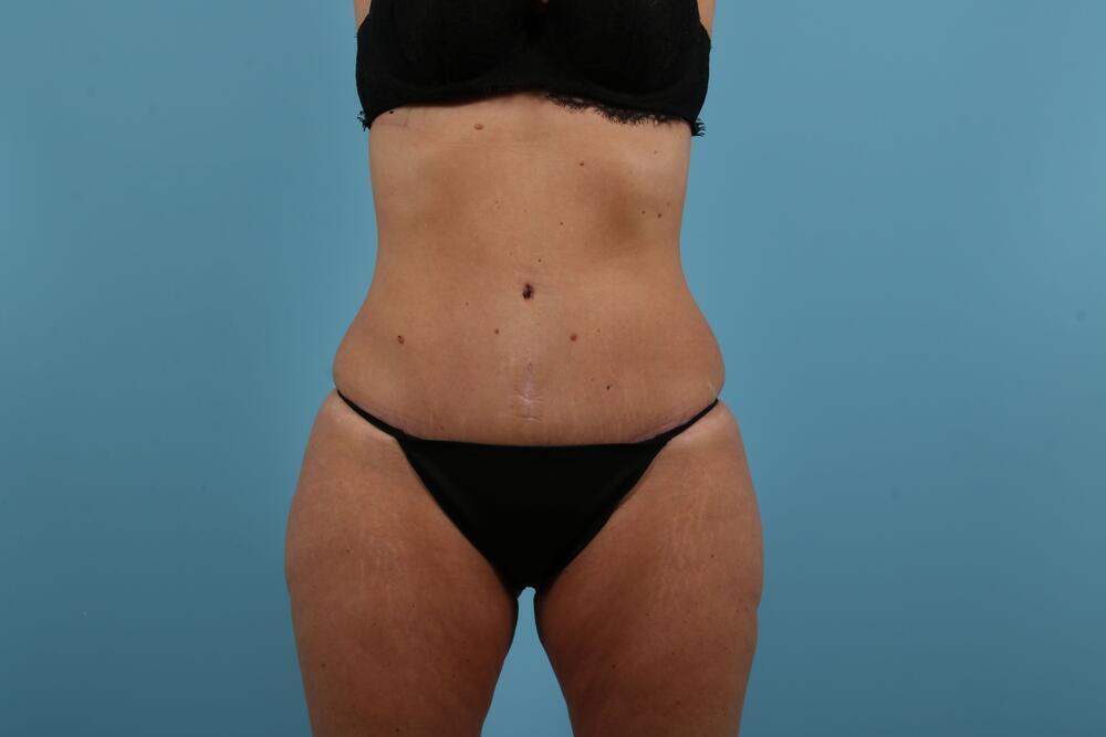 Abdominoplasty Before & After Image