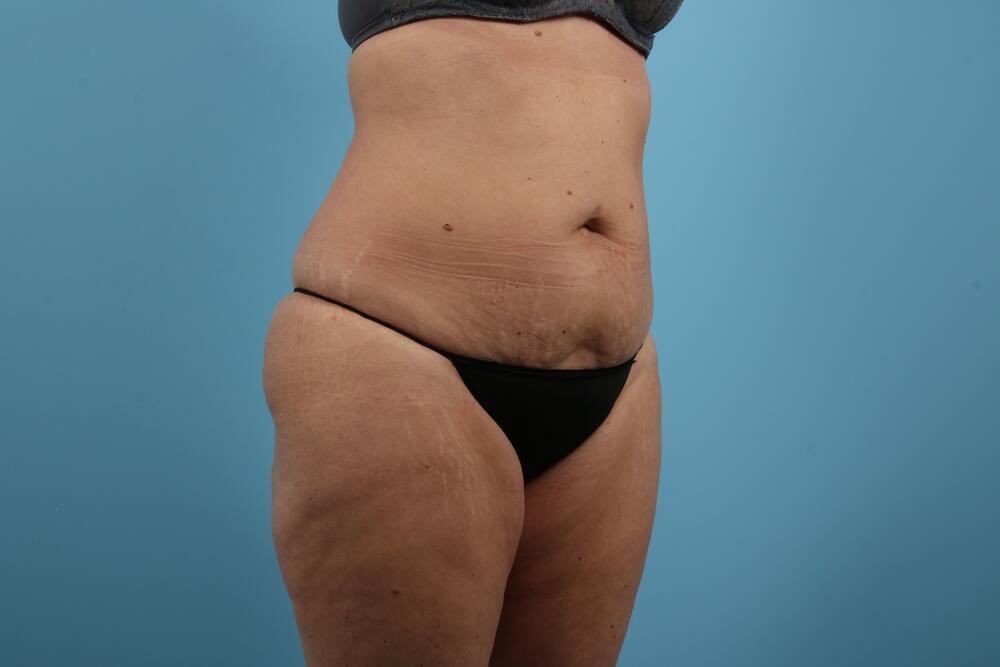 Abdominoplasty Before & After Image