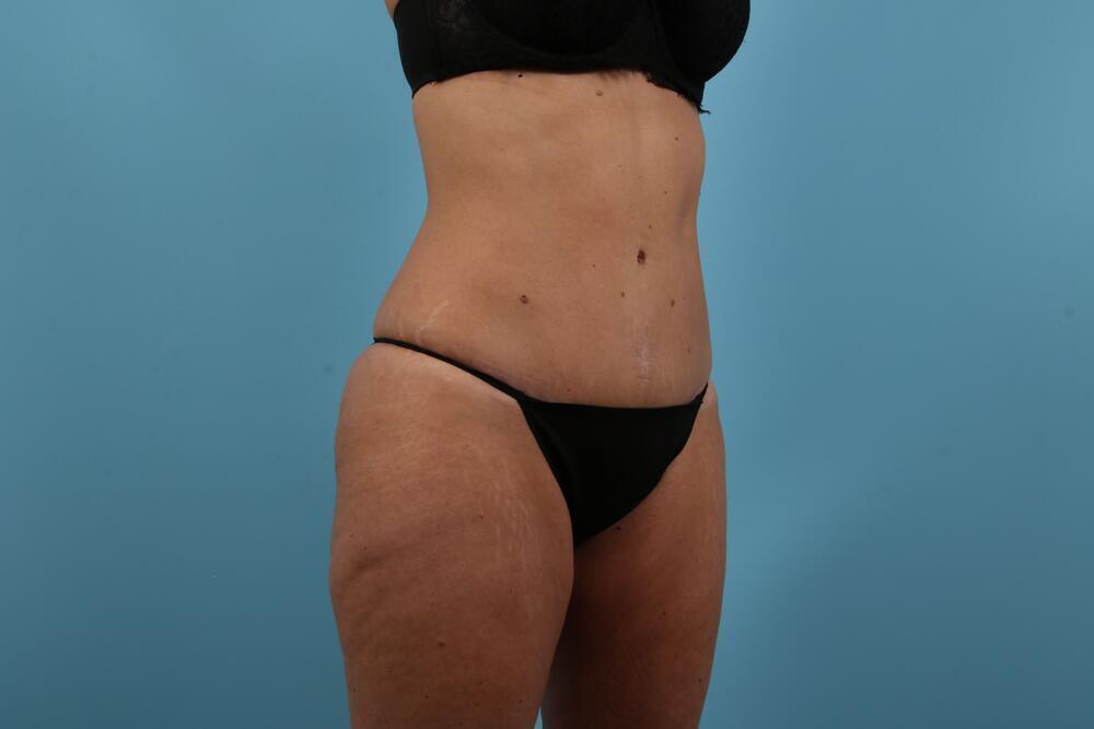 Abdominoplasty Before & After Image