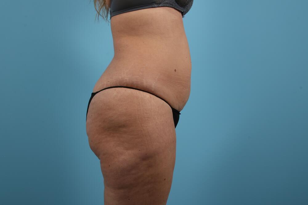 Abdominoplasty Before & After Image