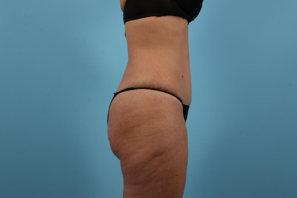 Abdominoplasty Before & After Image