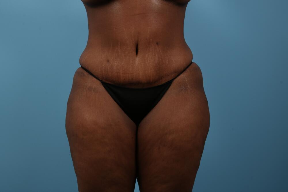 Abdominoplasty Before & After Image