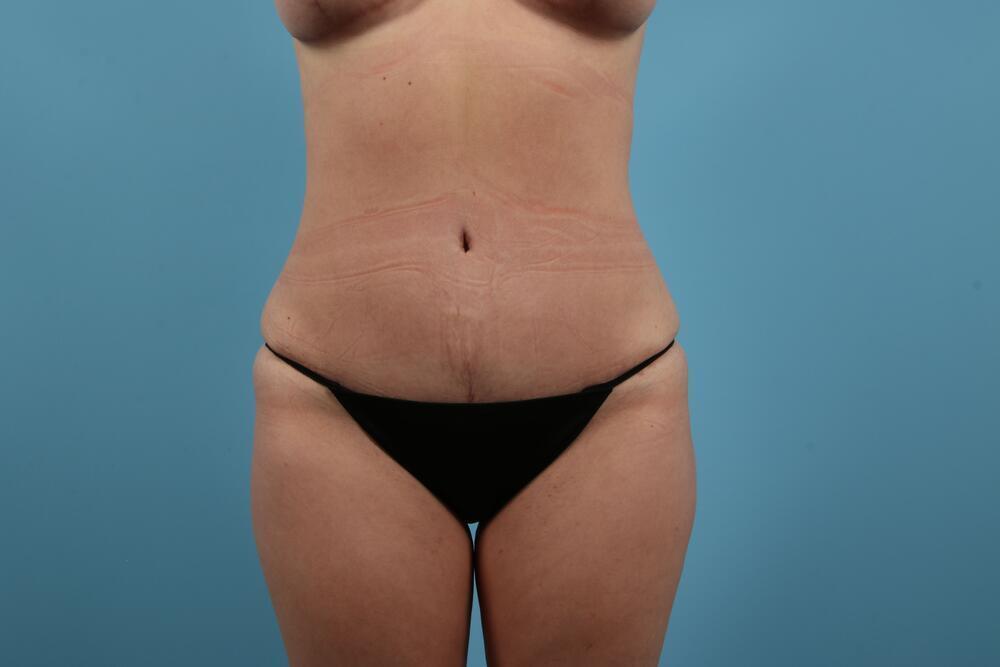 Abdominoplasty Before & After Image