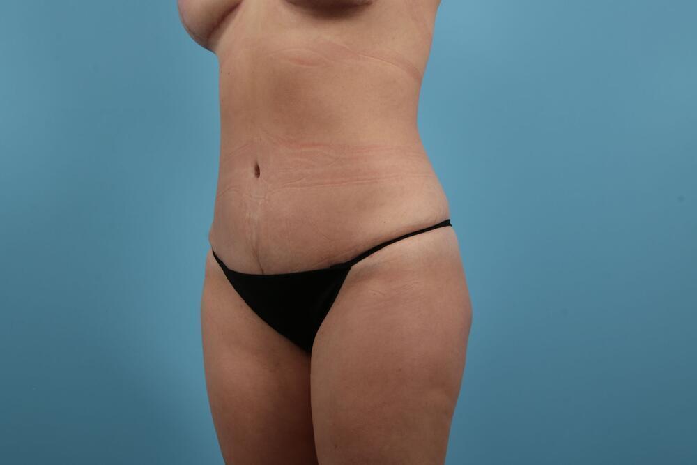 Abdominoplasty Before & After Image