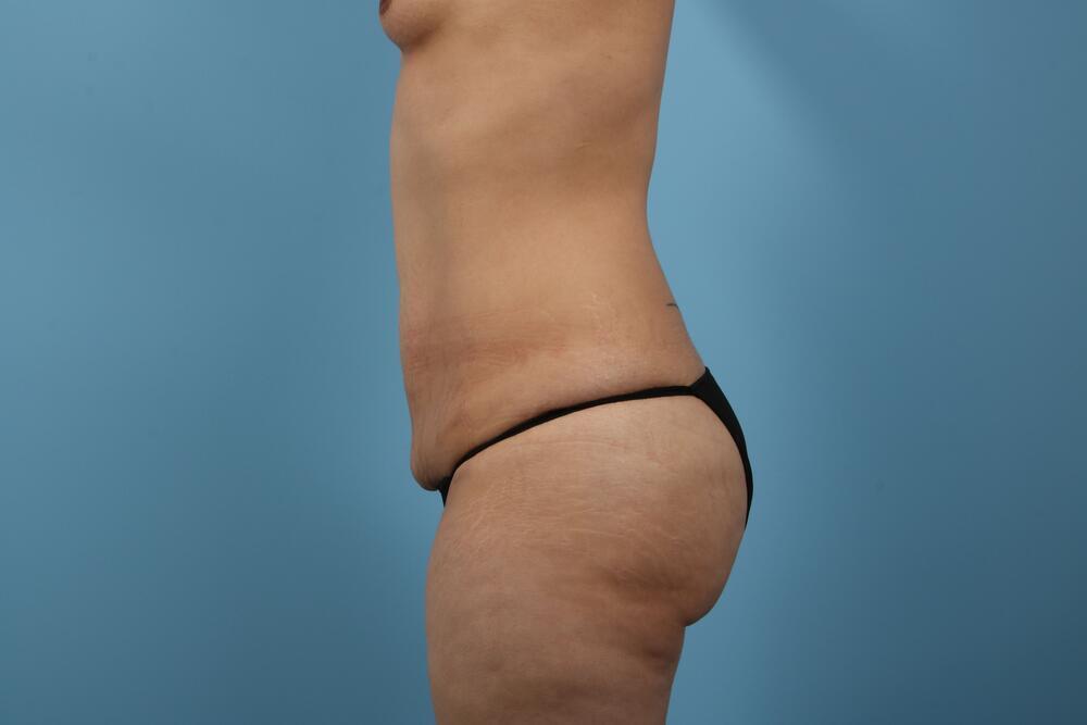 Abdominoplasty Before & After Image