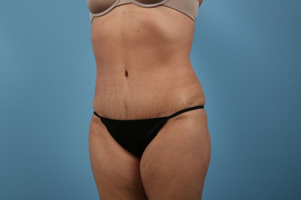 Abdominoplasty Before & After Image