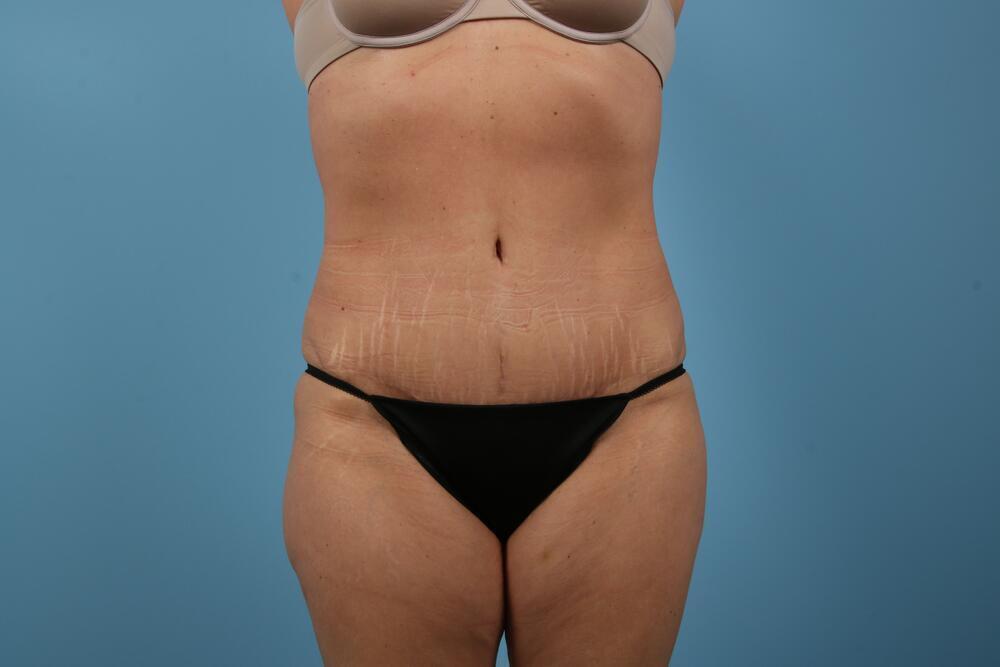 Abdominoplasty Before & After Image