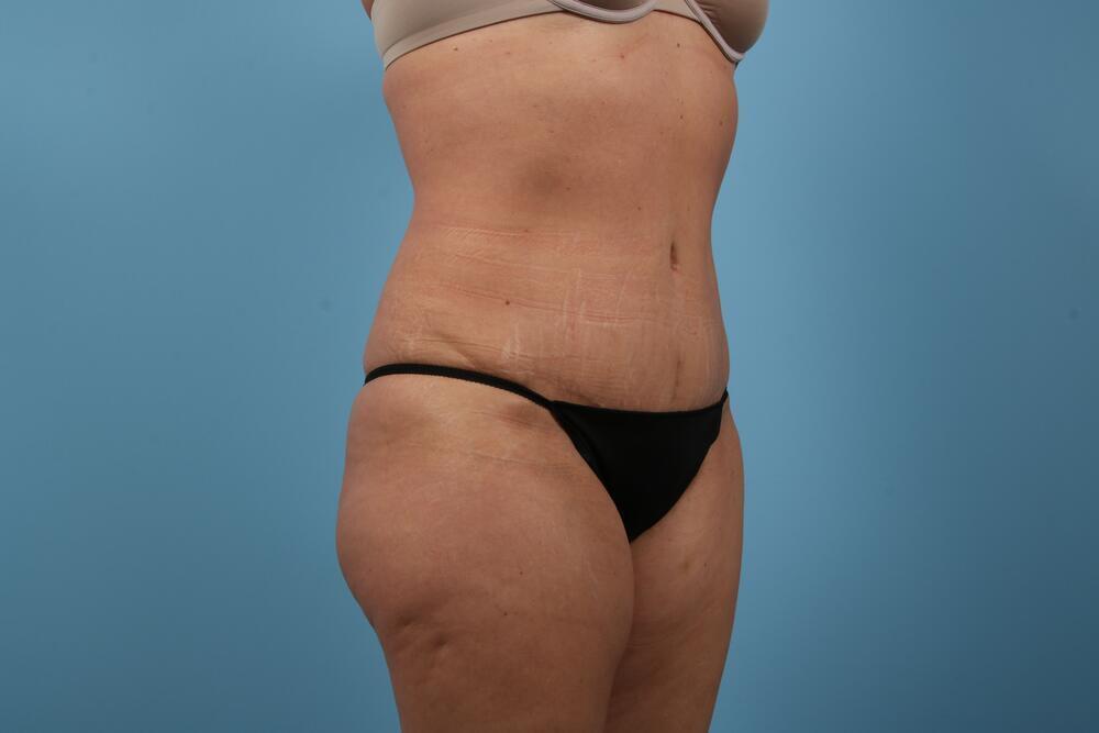 Abdominoplasty Before & After Image