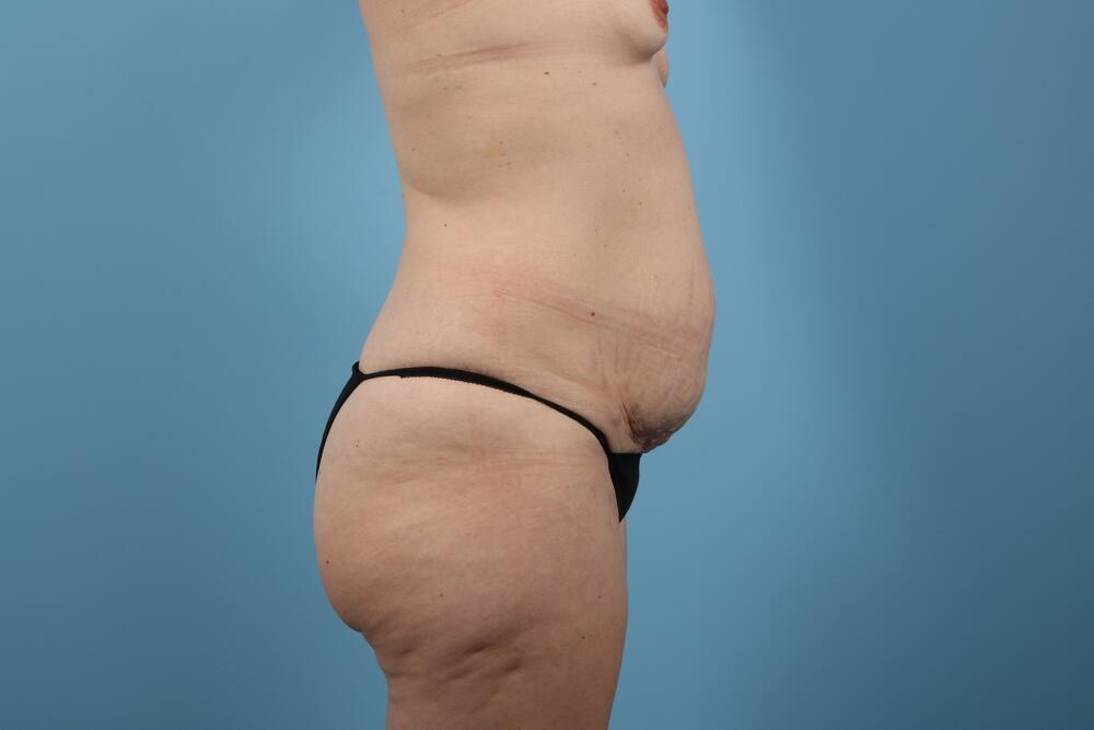 Abdominoplasty Before & After Image