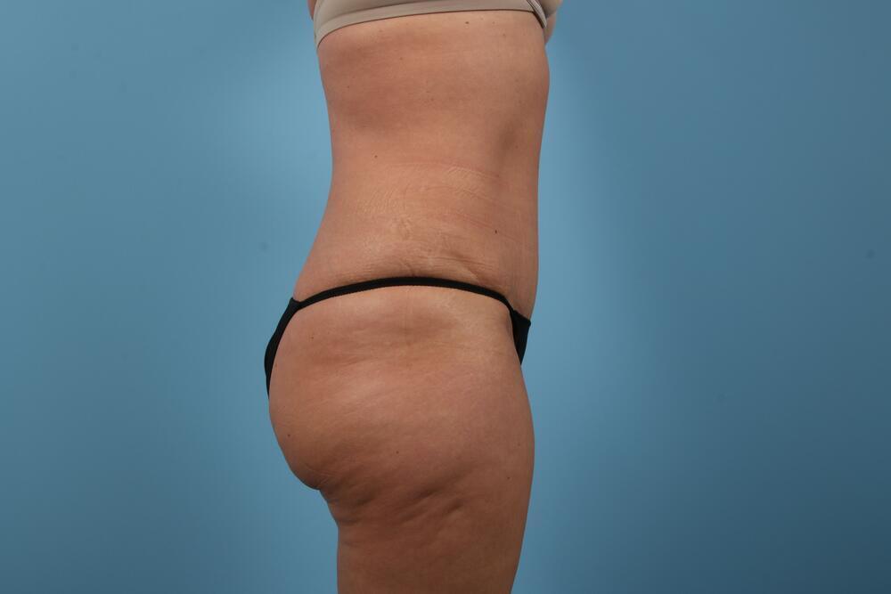 Abdominoplasty Before & After Image