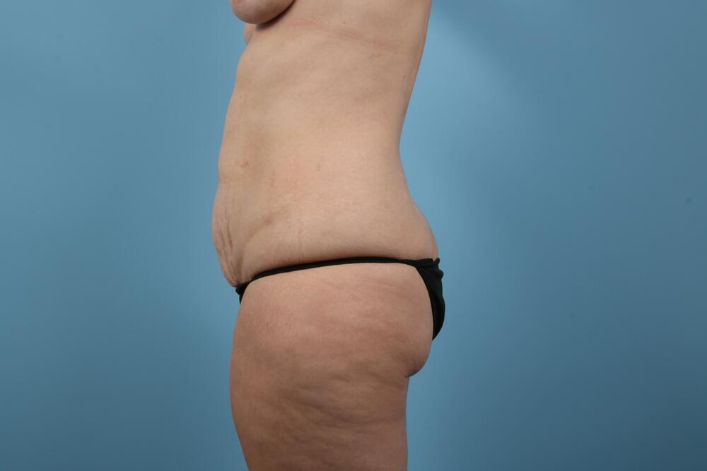 Abdominoplasty Before & After Image