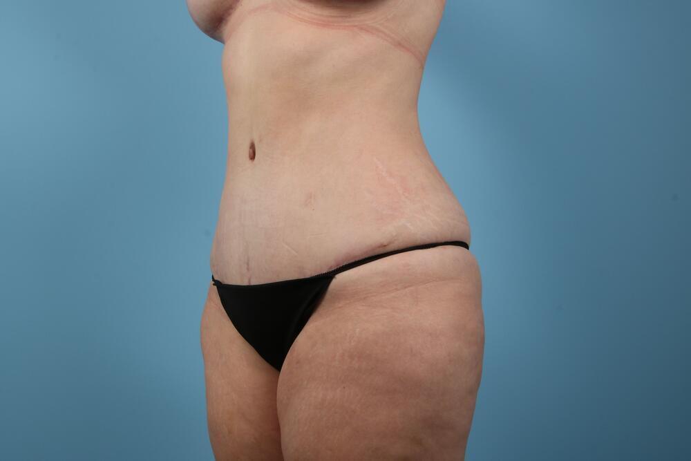 Abdominoplasty Before & After Image