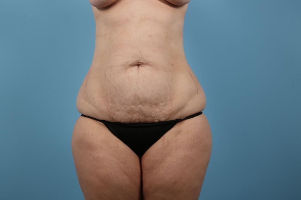 Abdominoplasty Before & After Image