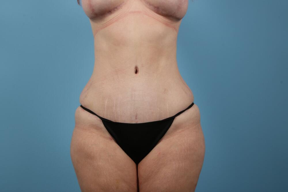 Abdominoplasty Before & After Image