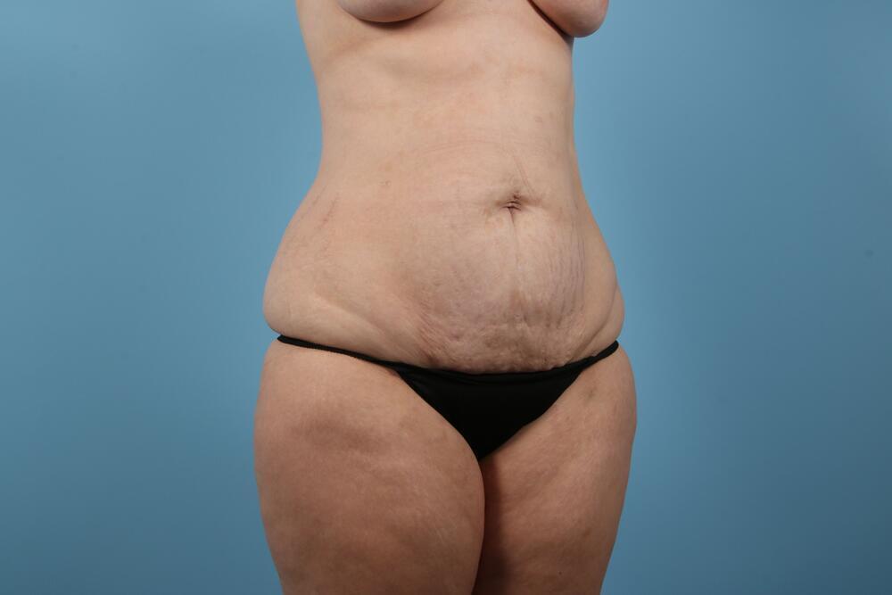 Abdominoplasty Before & After Image