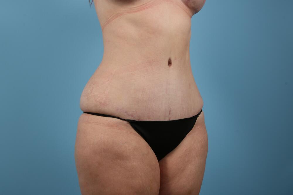 Abdominoplasty Before & After Image