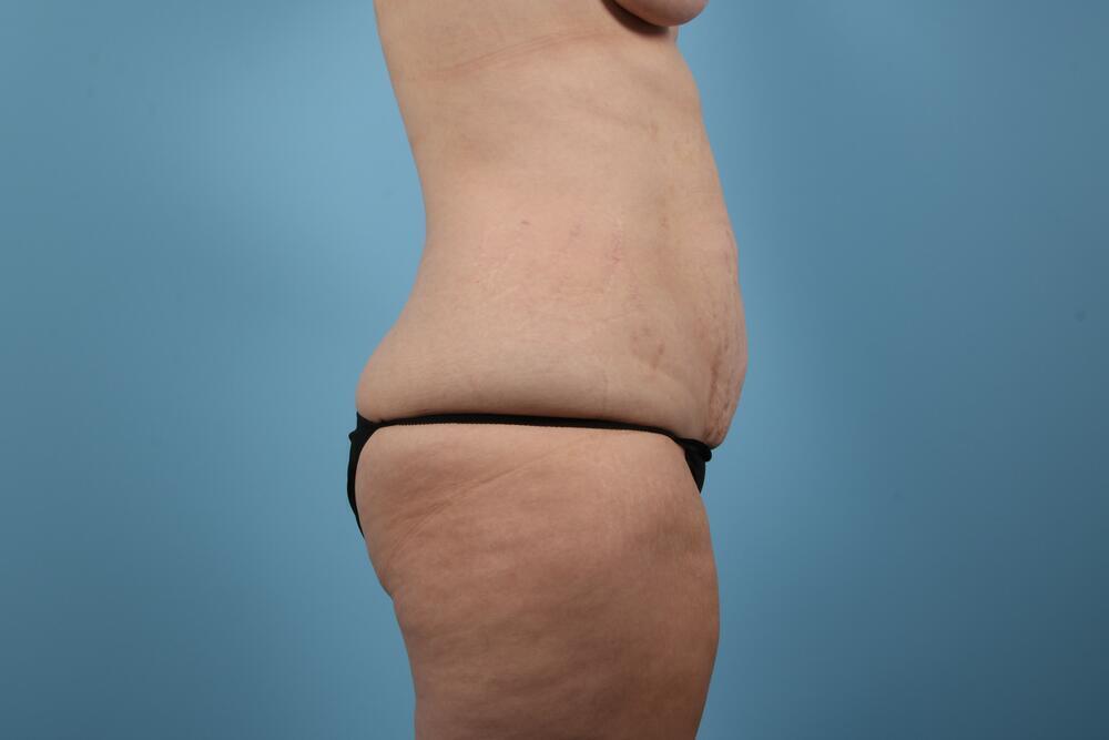 Abdominoplasty Before & After Image