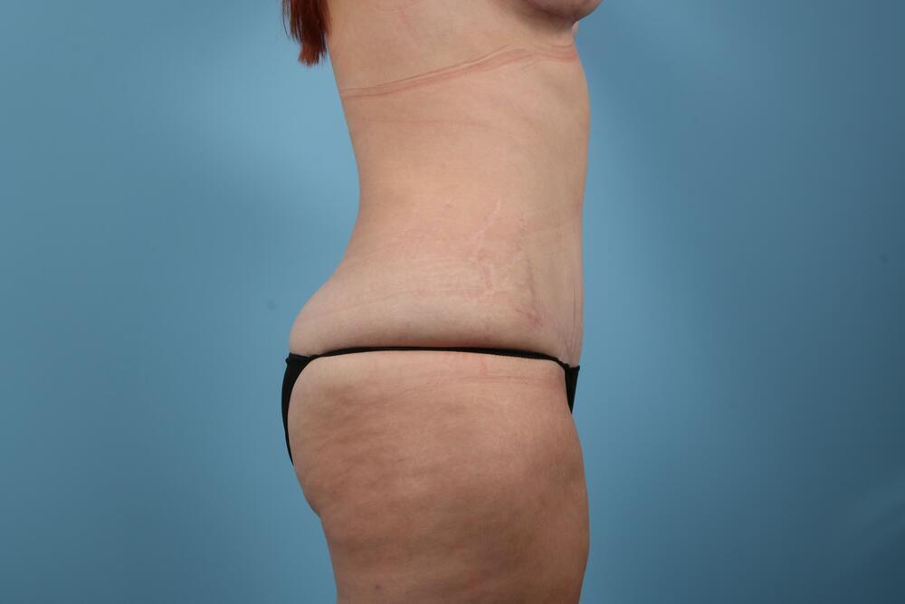 Abdominoplasty Before & After Image