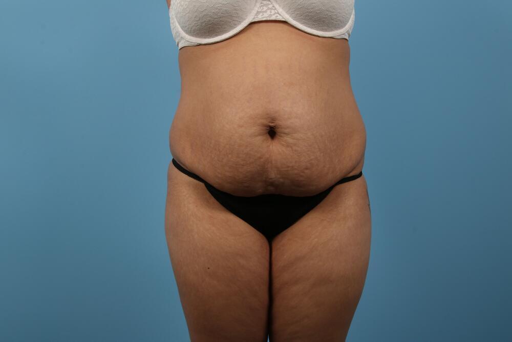 Abdominoplasty Before & After Image