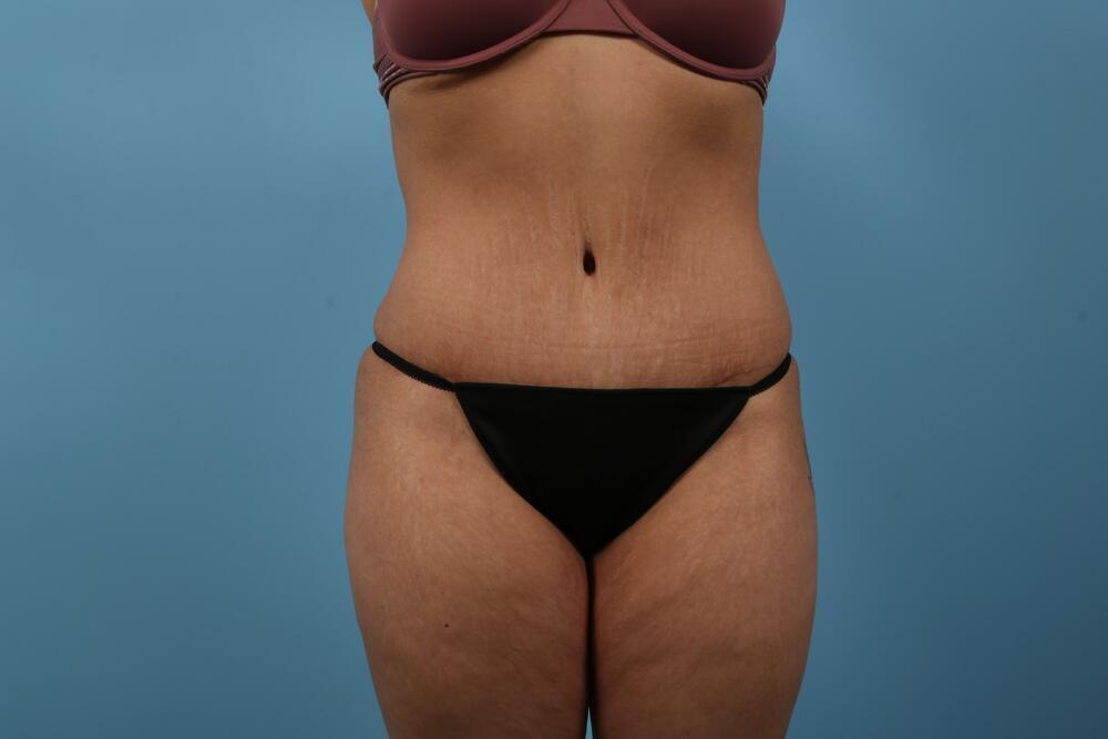 Abdominoplasty Before & After Image