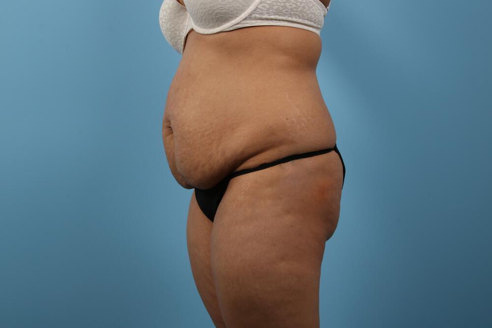 Abdominoplasty Before & After Image