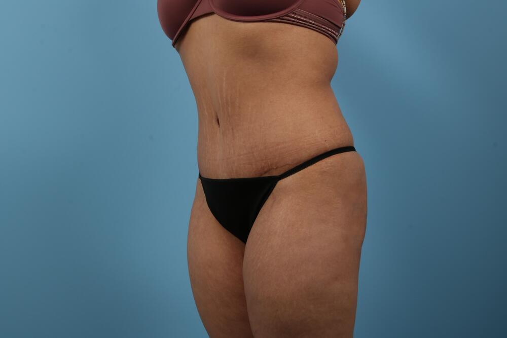 Abdominoplasty Before & After Image