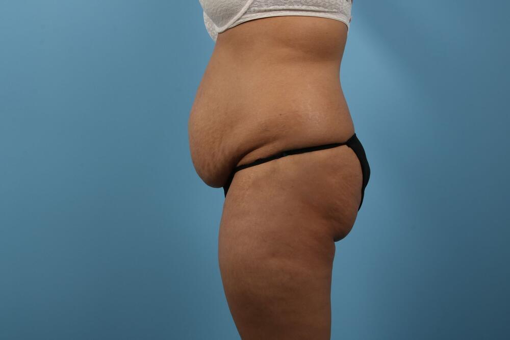 Abdominoplasty Before & After Image