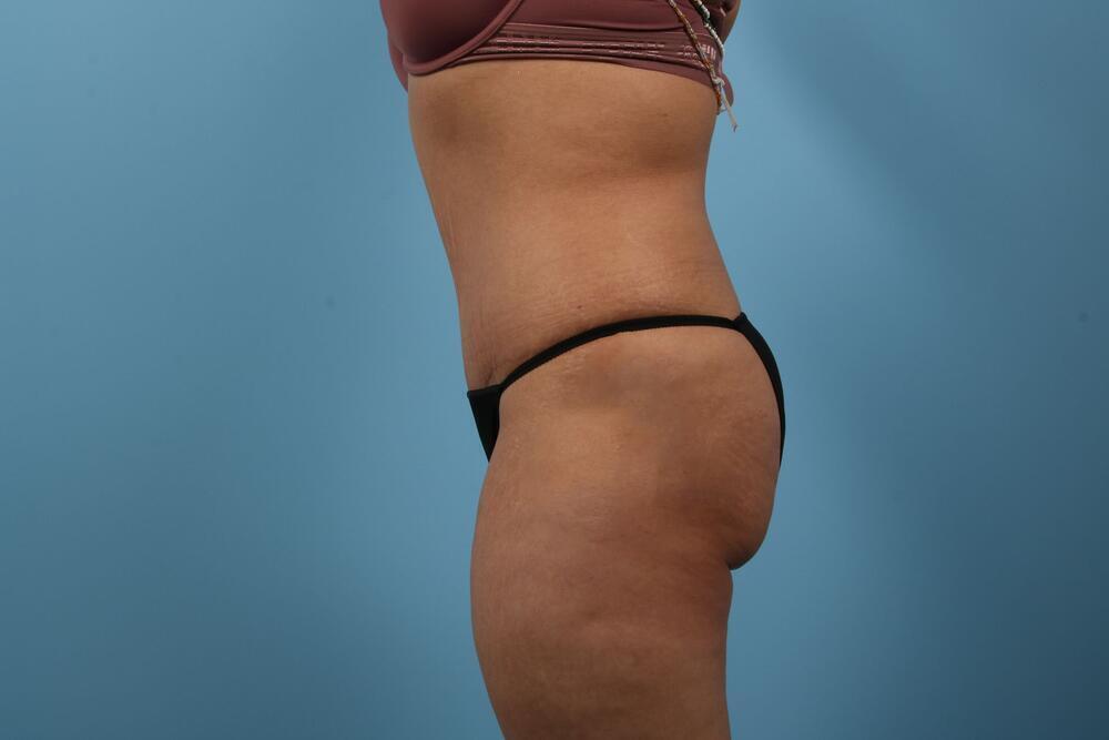 Abdominoplasty Before & After Image