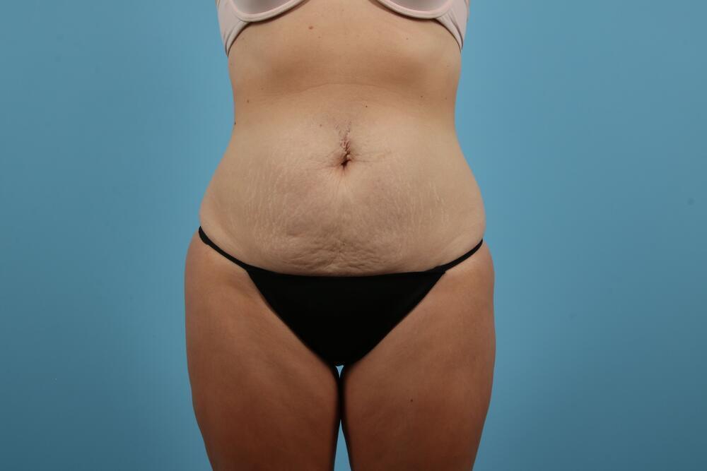 Abdominoplasty Before & After Image