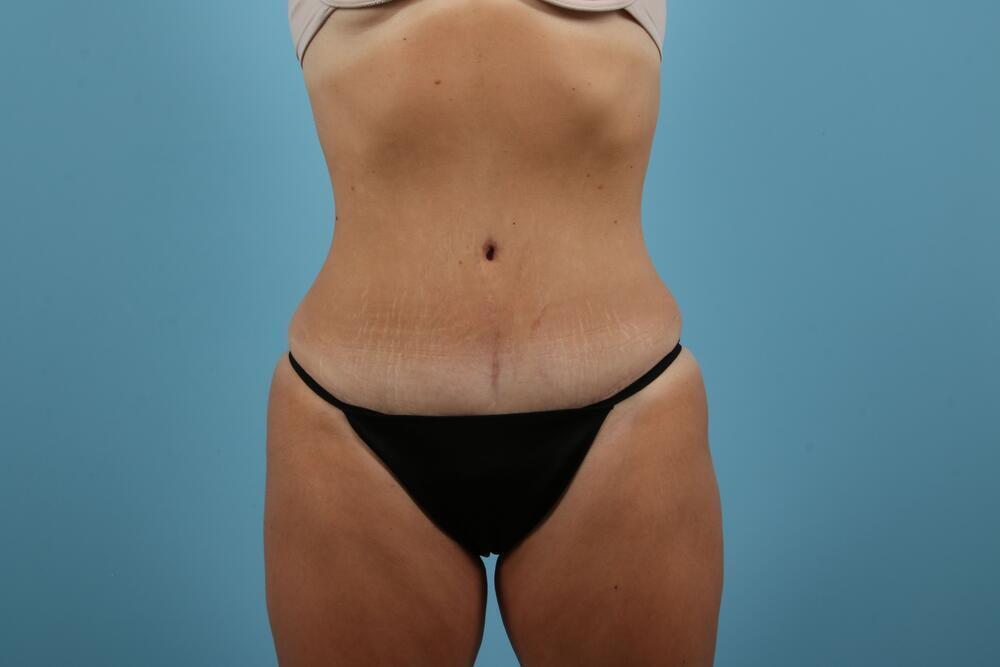 Abdominoplasty Before & After Image