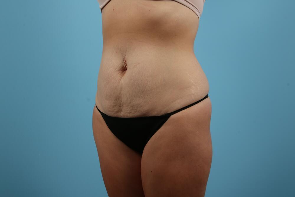 Abdominoplasty Before & After Image