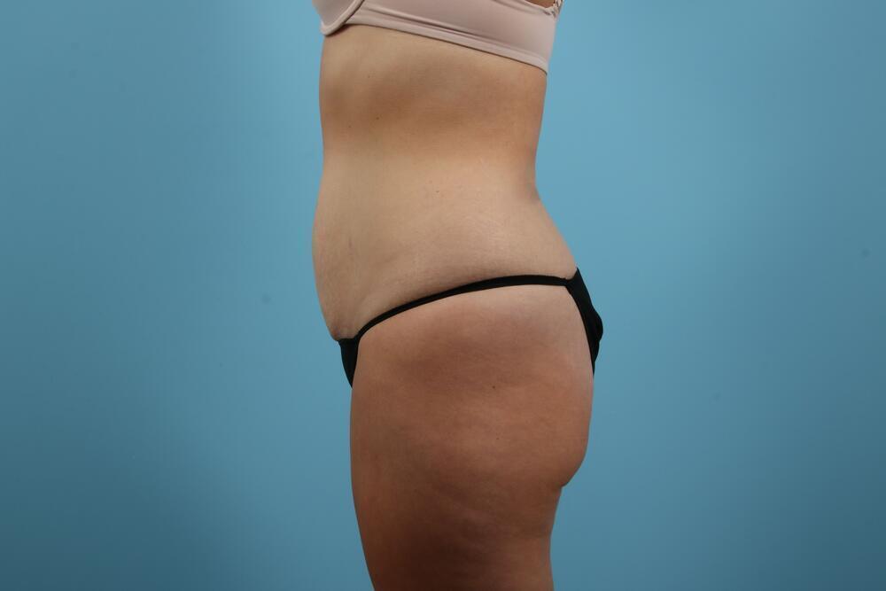 Abdominoplasty Before & After Image