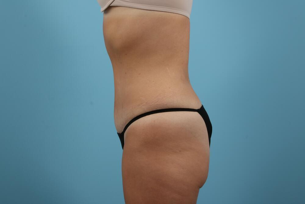 Abdominoplasty Before & After Image