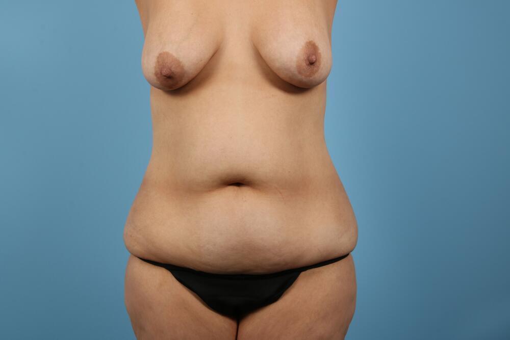 Abdominoplasty Before & After Image