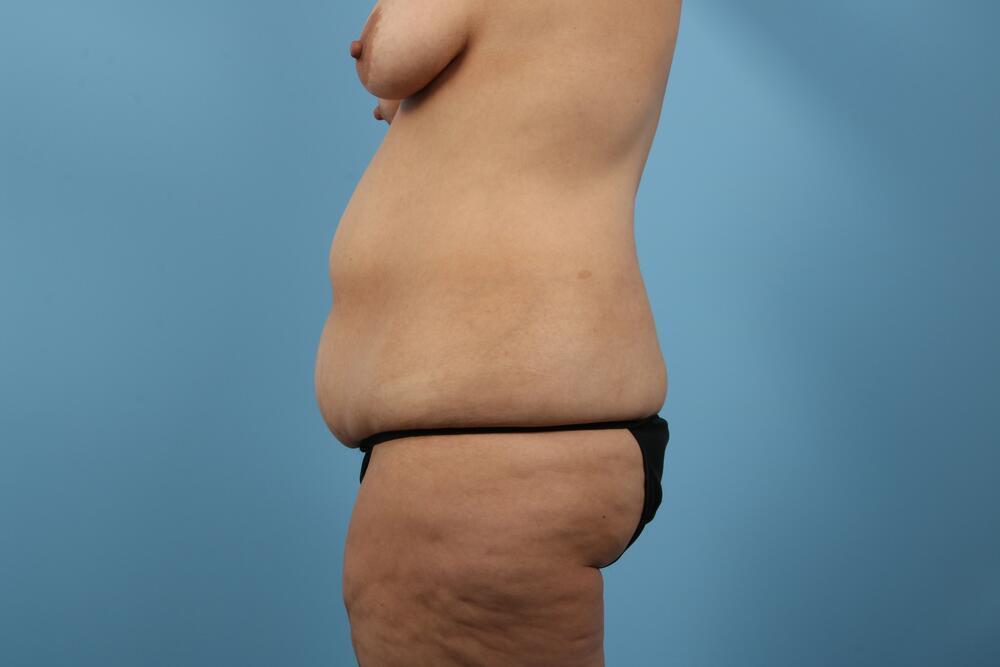 Abdominoplasty Before & After Image