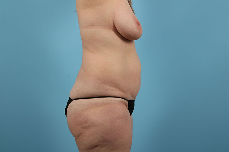 Abdominoplasty Before & After Image