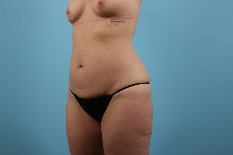 Abdominoplasty Before & After Image