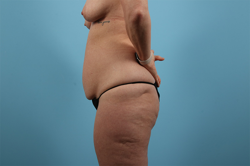 Abdominoplasty Before & After Image