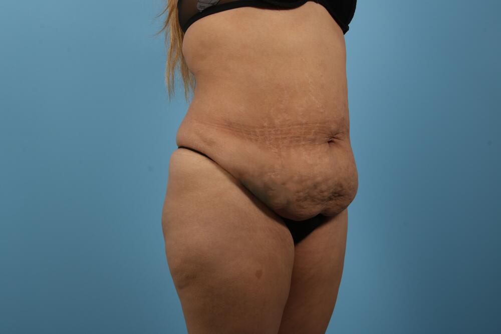 Abdominoplasty Before & After Image
