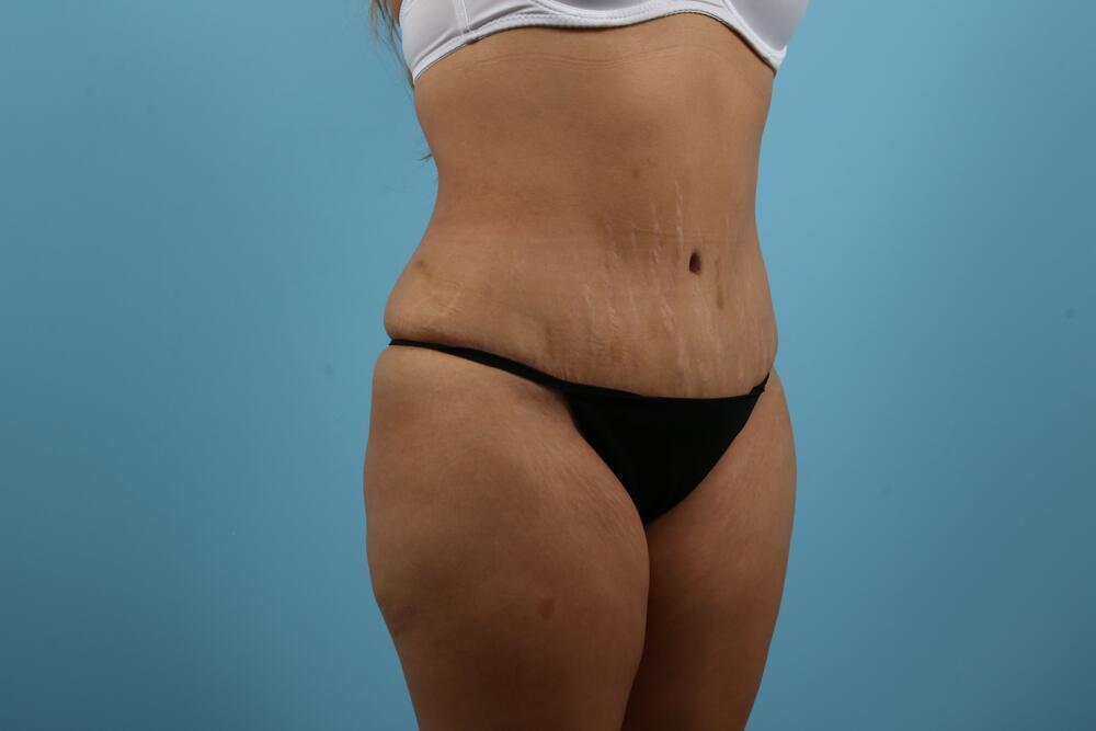 Abdominoplasty Before & After Image