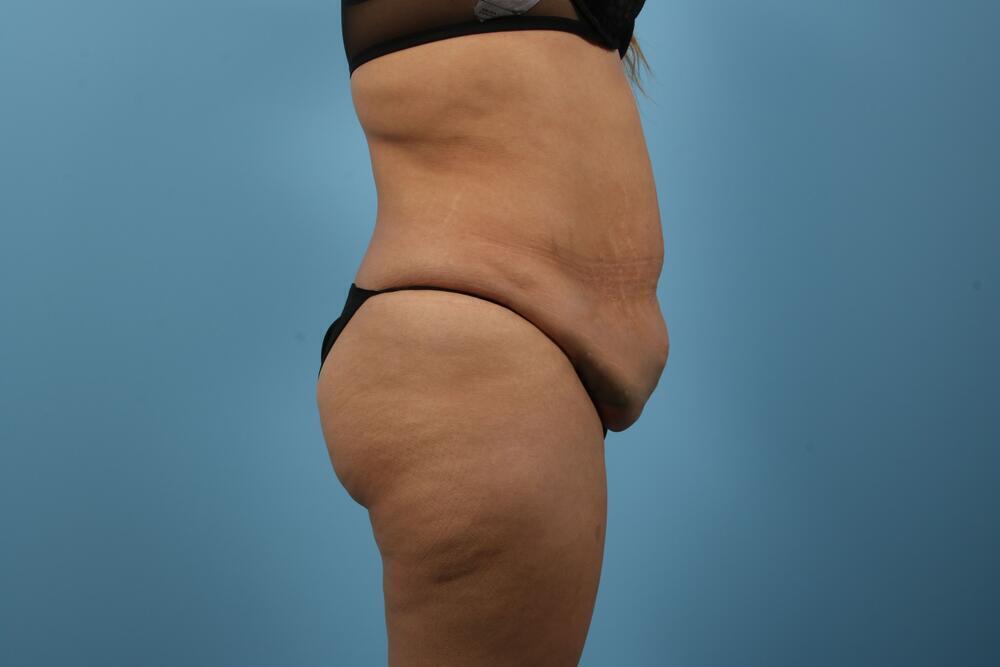 Abdominoplasty Before & After Image