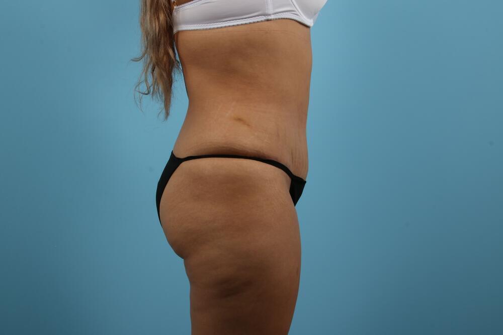 Abdominoplasty Before & After Image