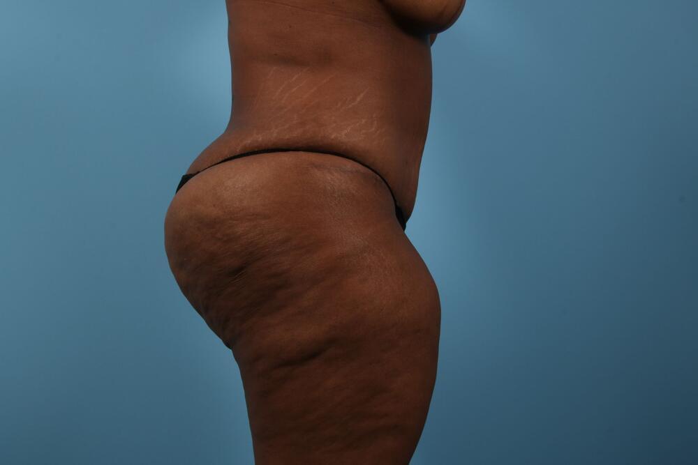 Abdominoplasty Before & After Image