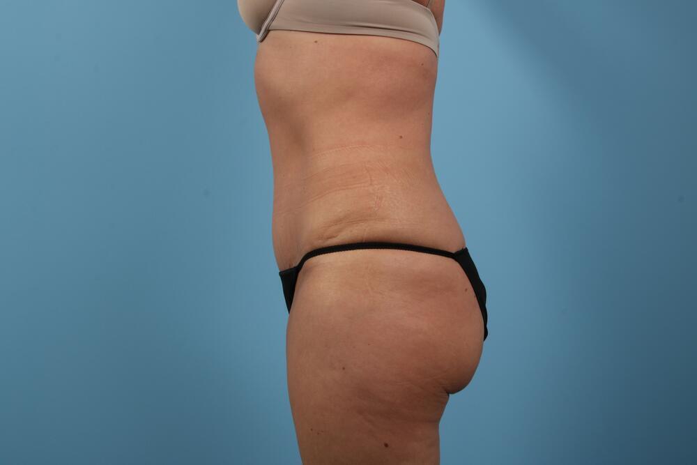 Abdominoplasty Before & After Image