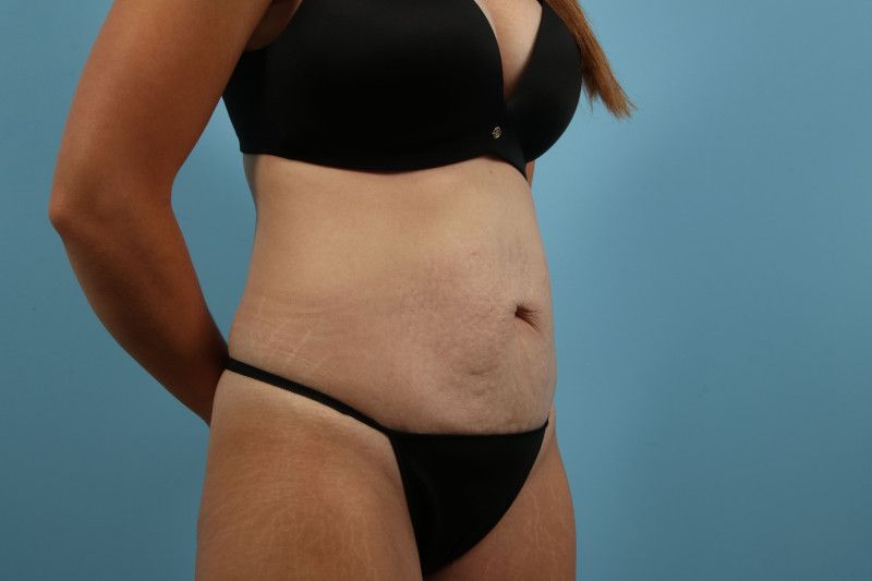 Abdominoplasty Before & After Image