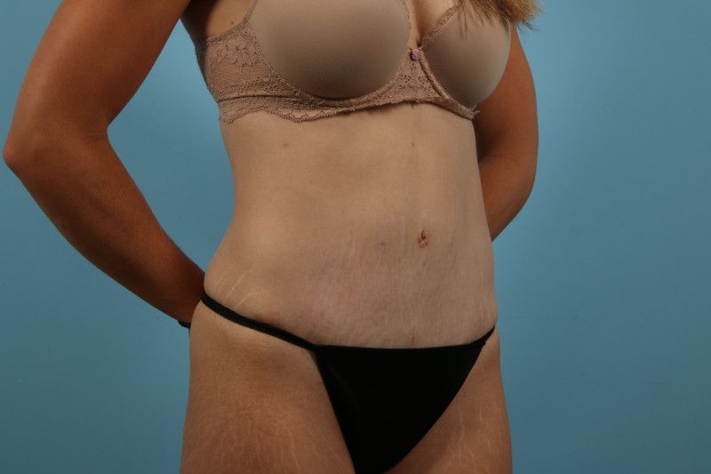 Abdominoplasty Before & After Image