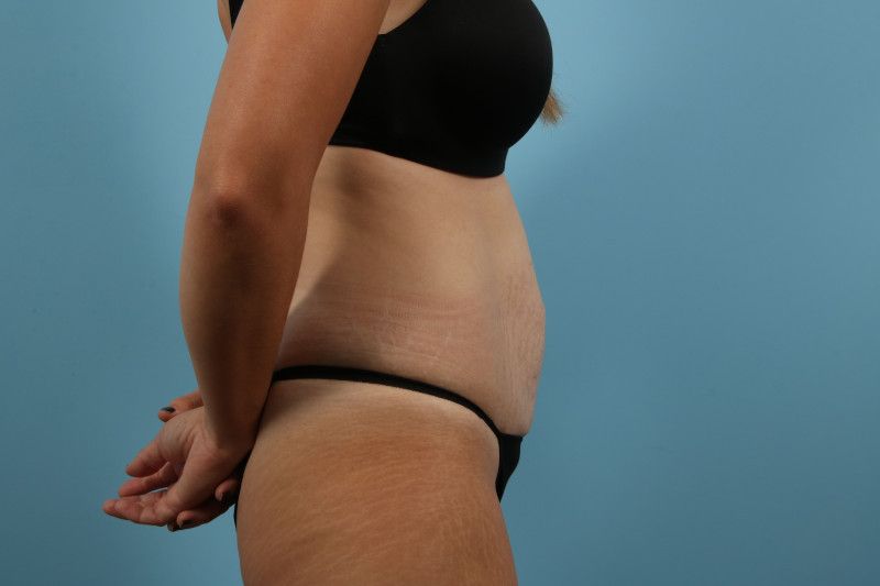 Abdominoplasty Before & After Image