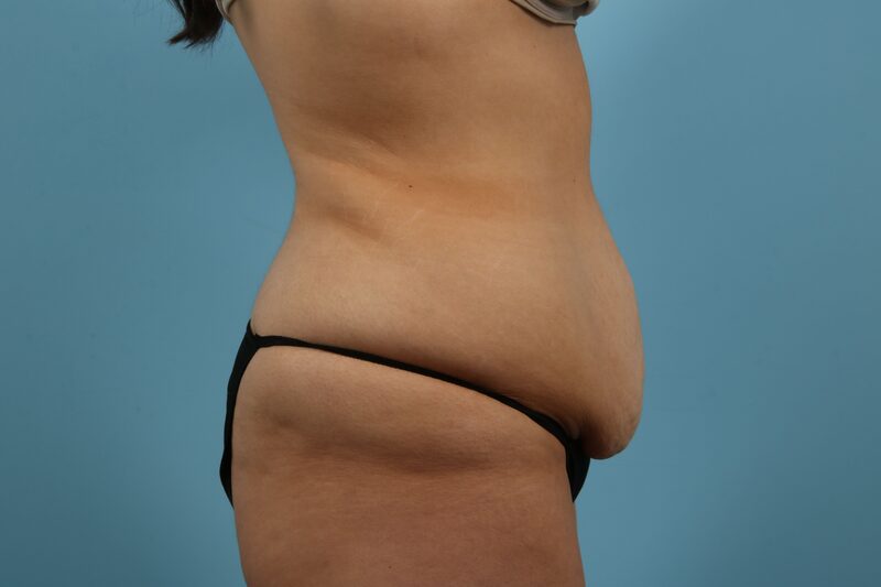 Abdominoplasty Before & After Image