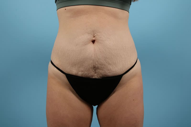 Abdominoplasty Before & After Image